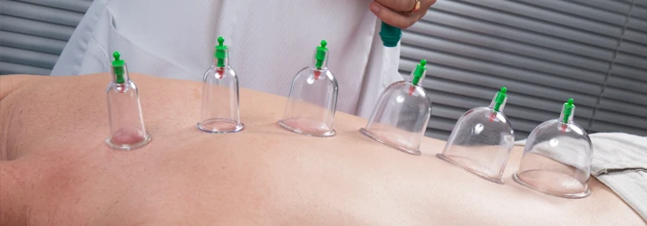 Acupuncture Anchorage AK Cupping